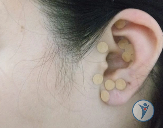 Detalle de auriculoterapia con balines en Puebla