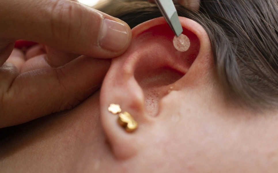 Sesión de auriculoterapia con balines en Puebla